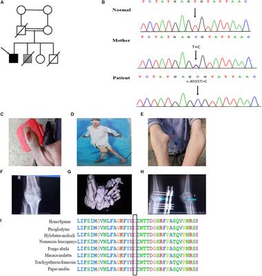 Case Report: Mutant SCN9A Susceptible to Charcot Neuroarthropathy in a Patient With Congenital Insensitivity to Pain